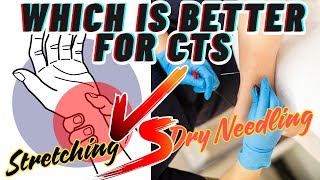 Physiotherapy Dry Needling Vs Stretching Which is better for Carpal Tunnel Syndrome [upl. by Fineberg215]