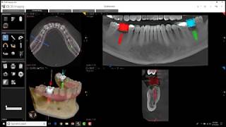 Carestream 3D Imaging  Cross Section Tool [upl. by Hartzke]