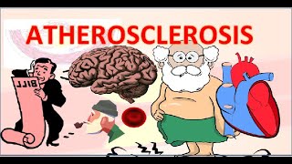 Atherosclerosis in hindi  एथेरोस्क्लेरोसिस  pathophysiology  pathogenesis [upl. by Yenahs]