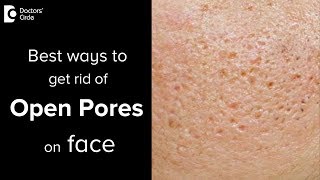 What are open pores and treatment options for that  Dr Vignesh Raj [upl. by Nyleahs]