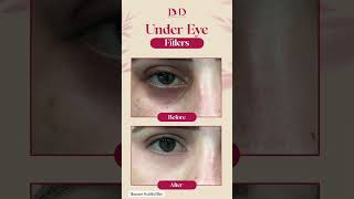 Under Eye Fillers by Dr Mubashir Daha Best Dermatologist in Islamabad  Islamabad skincare skin [upl. by Mastrianni744]