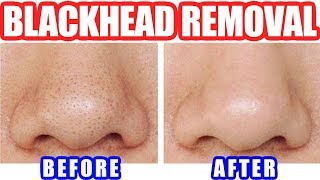 How to Remove Blackheads Best Blackhead Removal Easy Tool [upl. by Ikairik]