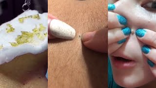 11 Minutes Of Top ASMR Pimple Popping Video [upl. by Noseaj]