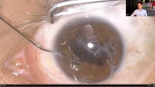 Lecture Secondary Intraocular Lens IOLs in Aphakia [upl. by Yearwood]