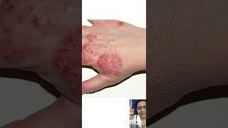 parasite infection symptoms parasite drmahimagudgille saikrishnahomoeopathicclinic [upl. by Haswell]