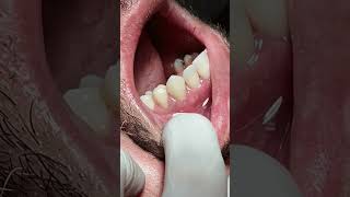 Tooth crowns after RCT satisfying [upl. by Yffub]