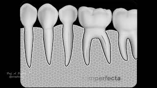 Dentinogenesis imperfecta [upl. by Sinclare]