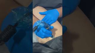 Esthetician performs cellulite treatment on the leg and thigh shorts [upl. by Ssor]