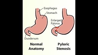 Embryological basis for Congenital hypertrophic Pyloric stenosis [upl. by Grannia]