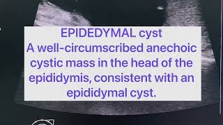 Epidedymal Cyst [upl. by Aicetal311]