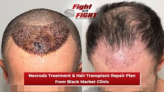 Necrosis from Black Market Clinic  Treatment amp Hair Transplant Repair Plan by Maxim Chumak MD [upl. by Ahsenak]