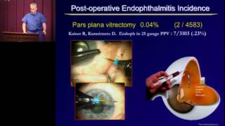 Post Operative Endophthalmitis [upl. by Coppola]