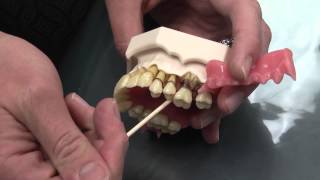 What is Periodontal Disease [upl. by Grantham]