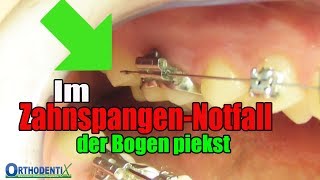 Im ZahnspangenNotfall der Bogen piekst feste Zahnspange Kieferorthopäde  Orthodentix [upl. by Deuno]