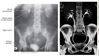 Radiographic Contrast Studies of the Urinary System [upl. by Bunch]