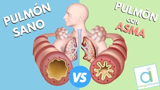 ¿Pulmón SANO 😁 VS pulmón con ASMA😩 [upl. by Pembroke1]