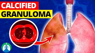 What is a Calcified Granuloma in the Lungs [upl. by Tekcirc]