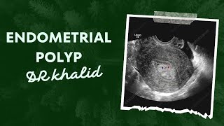 endometrial polyp [upl. by Leckie]