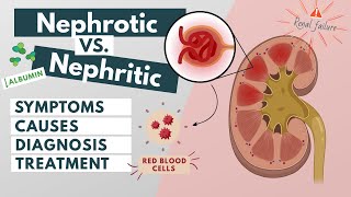 Nephrotic vs Nephritic syndrome  Symptoms diagnosis causes treatment  Visual explanation [upl. by Eseerahs349]