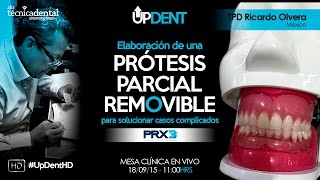 Elaboración de una Prótesis Parcial Removible para solucionar casos complicados [upl. by Haem]