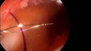 Arthroscopic Medial patella plication Dr A Reznik [upl. by Elmajian393]