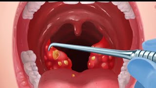 This is how tonsil stones are removed and tooth implant [upl. by Airotkciv]