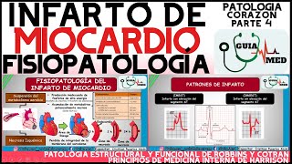 INFARTO AGUDO AL MIOCARDIO FISIOPATOLOGÍA  GuiaMed [upl. by Leamiba]