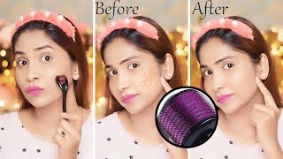 How I got rid of my acne scars  घर बैठे चेहरे के गड्ढो को ऐसे किया जाता है स्मूथ Microneedling से [upl. by Nileuqcaj964]