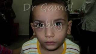 الحول الوحشي المتقطع  Intermittent Exotropia [upl. by Pease762]