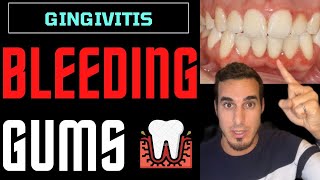 GINGIVITIS treatment and symptoms  INFLAMED GUMS and GUM DISEASE [upl. by Halian554]