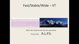 ACLS 2020 Algorithm Tachycardia [upl. by Lefkowitz936]