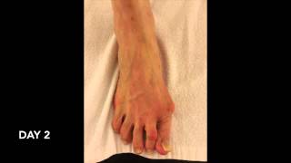 Non Surgical Correction of Severe deformed feet [upl. by Vinay]