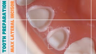 Tooth Preparation 🔵 Maxillary Lateral Incisor 🟡 PFM [upl. by Nauqe877]