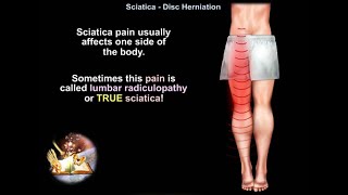 Low back pain Sciatica Disc Herniation  Everything You Need To Know  Dr Nabil Ebraheim [upl. by Cutcheon86]