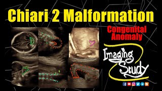 Chiari 2 Malformation  Ultrasound  Anomaly  Case 287 [upl. by Edie]