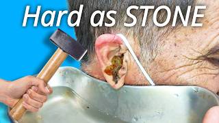 Another level of Ear Wax Cleaning earwaxremoval earcleaning satisfying [upl. by Miguel822]