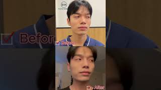 Mens Rhinoplasty Find out now 🩷 koreaplasticsurgerybeforeafter [upl. by Er290]