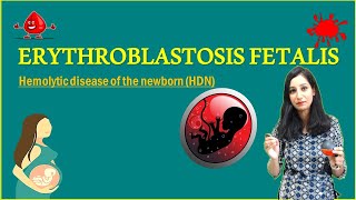 ERYTHROBLASTOSIS FETALIS II Hemolytic disease of the newborn HDN [upl. by Lundeen]