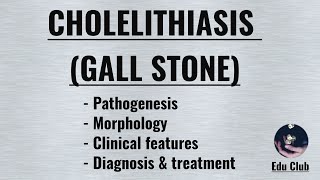 Cholelithiasis Gall Stone  Cholesterol stone  Pigment stone [upl. by Rhoda]