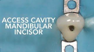 Pre Clinical Endodontic  Access Cavity of Mandibular Incisor [upl. by Nyvlem685]