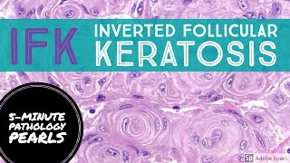 IFK Inverted Follicular Keratosis 5Minute Pathology Pearls [upl. by Levins]