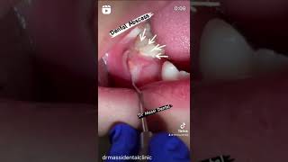 Dental Abscesses on baby tooth [upl. by Allayne]