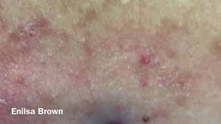 Christians Acne Back Treatment Blackheads Extractions [upl. by Ecyor170]