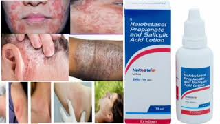 Halovate S Lotion Halobetasol Propionate and Salicylic Acid Lotion [upl. by Ahscrop]