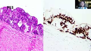 Tip82 Highgrade Appendiceal Mucinous Neoplasm [upl. by Garihc291]