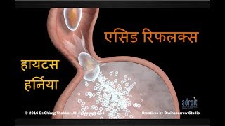 एसिड रिफ्लक्स एसिडिटी Hiatus Hernia और GERD की संपूर्ण जानकारी Acid Reflux Acidity heartburn [upl. by Ledniahs]