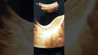 Nabothian cyst in cervix [upl. by Jaime]