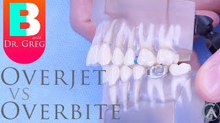 BRACES EXPLAINED Overbite vs Overjet [upl. by Shelba]