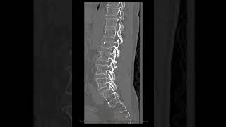 Fratura de corpos vertebrais com hematoma epidural anterior [upl. by Nolos222]