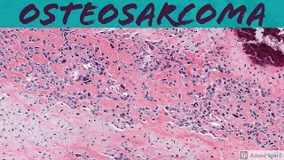 Osteosarcoma 101 Bone Pathology Basics [upl. by Asilenna]